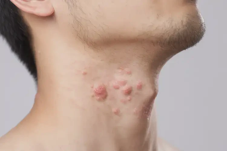 青年人脖子容易長濕疹可以徹底自愈嗎(圖4)