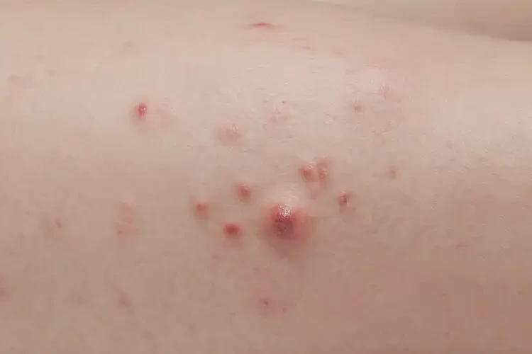 少兒大腿上容易起濕疹能夠徹底治愈嗎(圖4)