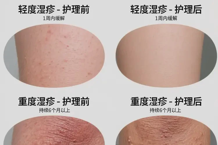 兒童手臂經(jīng)常長(zhǎng)濕疹不管它會(huì)自己好嗎(圖1)