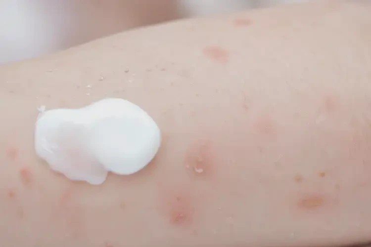 寶寶手臂上出濕疹能徹底自愈嗎(圖3)