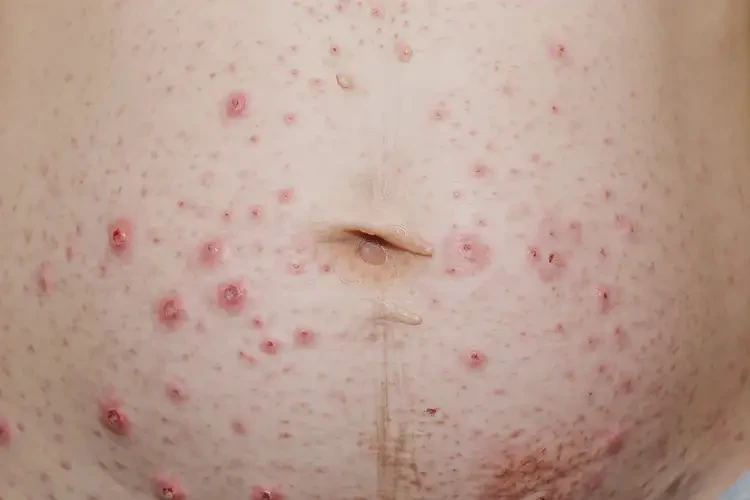 產(chǎn)婦肚子上偶爾長(zhǎng)濕疹不管它會(huì)自己自愈嗎(圖4)