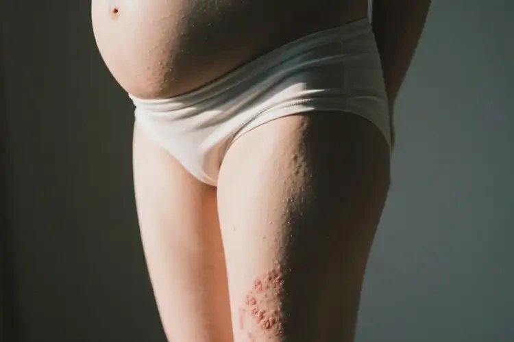 產(chǎn)婦大腿偶爾長濕疹不管它會自己自愈嗎(圖1)