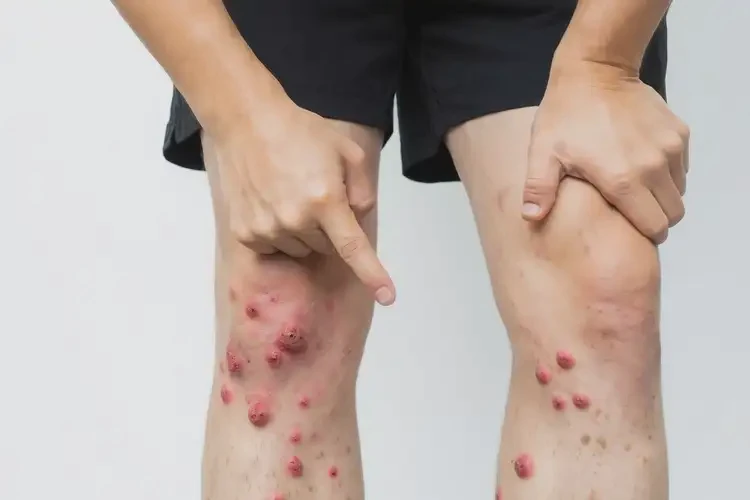 青年人小腿上出濕疹不管它會自己好嗎(圖4)