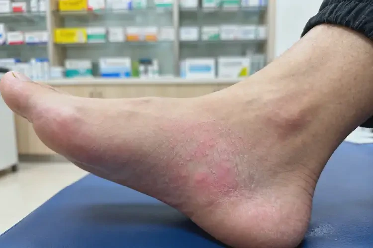 青年人脚上长湿疹可以彻底自愈吗(图4)