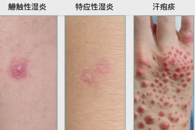 青年人腳上容易長(zhǎng)濕疹不管它會(huì)自己好嗎(圖3)