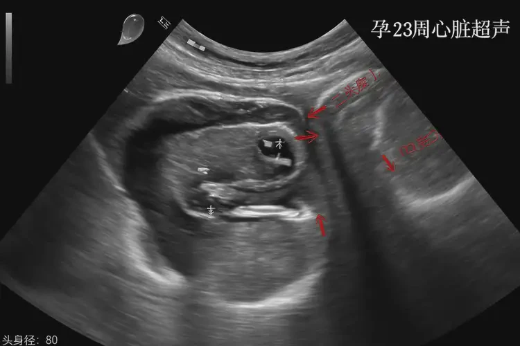 孕23周胎心73寶寶還能要嗎(圖4)