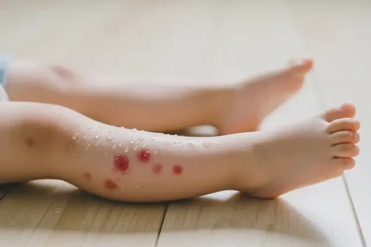 孩子小腿有濕疹可以徹底自愈嗎(圖3)