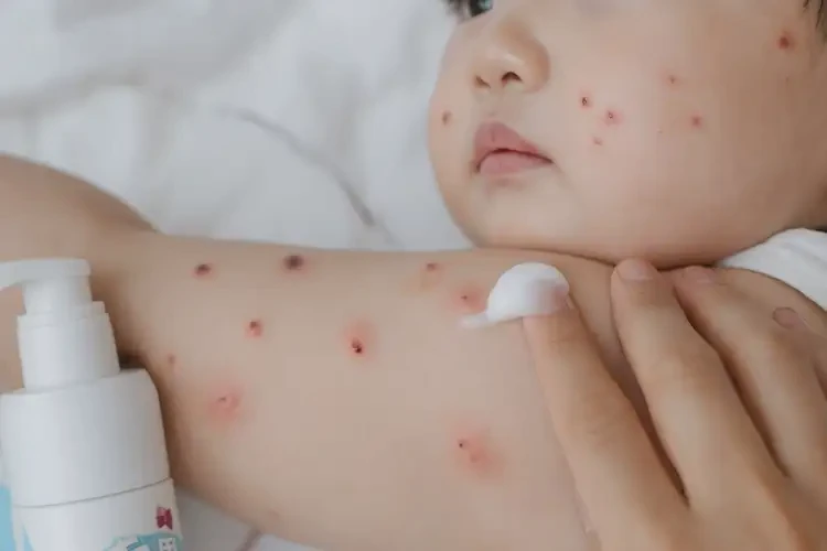 寶寶全身有濕疹能靠自己自愈嗎(圖4)