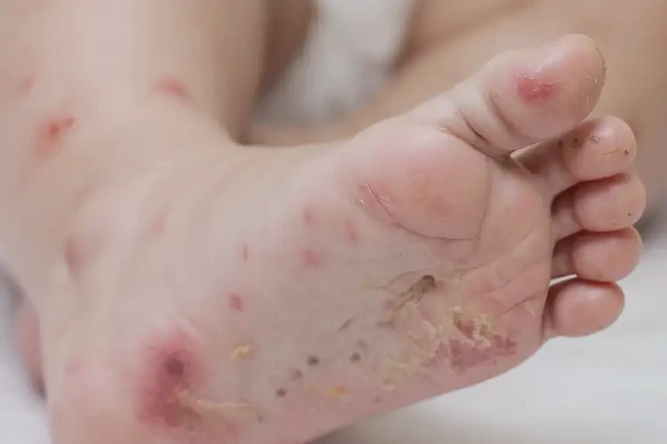 幼兒腳上容易長濕疹能靠自己自愈嗎(圖4)