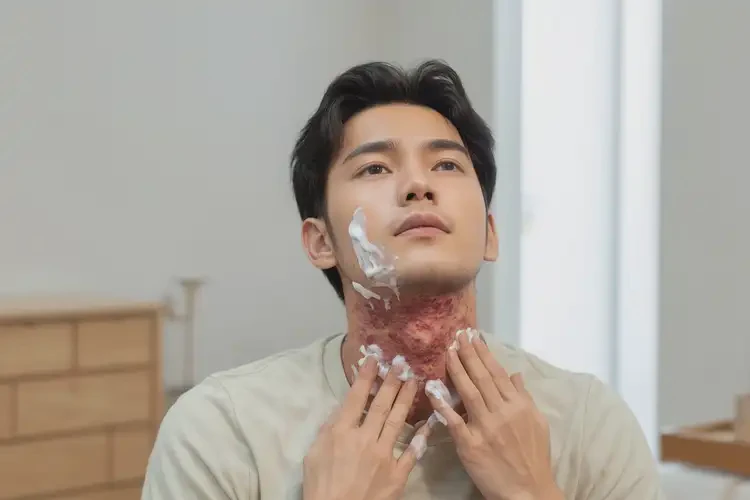 青年人脖子上起濕疹可以徹底自愈嗎(圖2)