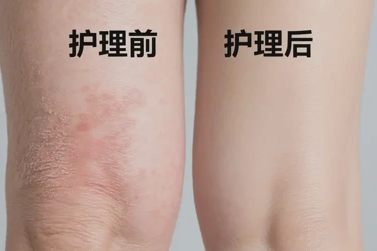 老年人小腿上偶爾起濕疹可不可以徹底自愈(圖3)
