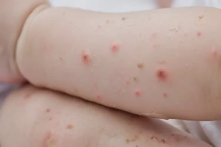寶寶四肢容易起濕疹能徹底自愈嗎(圖4)