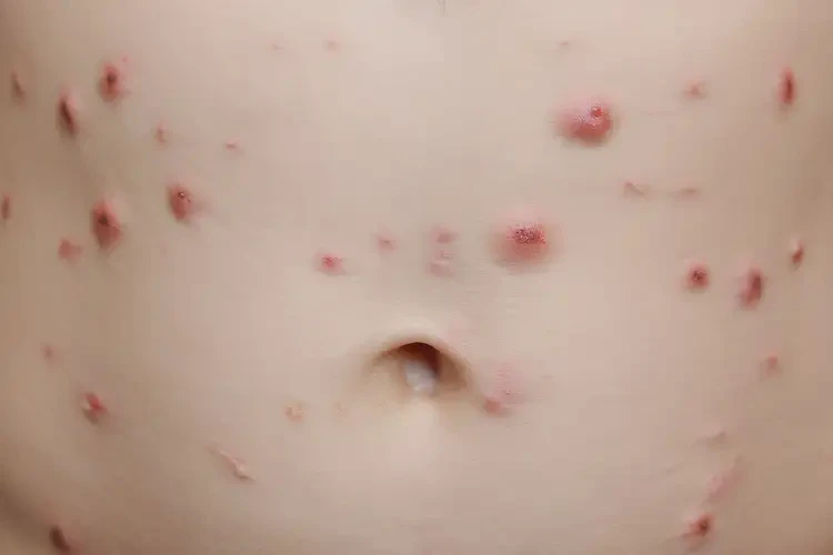 小兒肚子上起濕疹可以徹底自愈嗎(圖4)