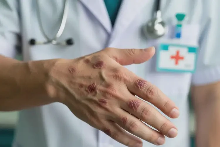 男人手上出現(xiàn)濕疹不管它會自己好嗎(圖1)