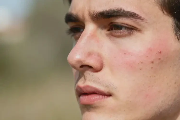 男人臉上偶爾長濕疹不管它會自己自愈嗎(圖1)