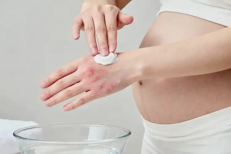 孕婦手上有濕疹不管它會(huì)自己好嗎(圖1)