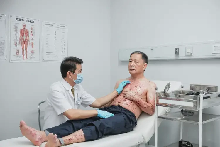 男生小腿上偶爾長濕疹可不可以徹底自愈(圖4)