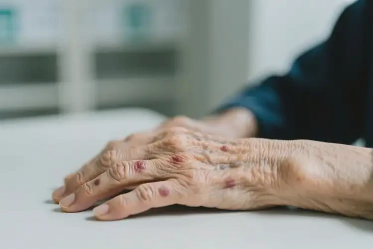 高齡老人身上起濕疹不管它會自己好嗎(圖1)