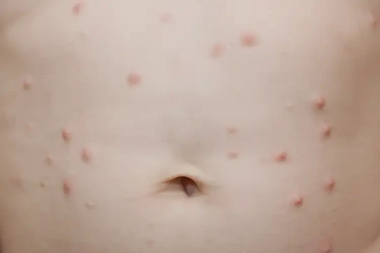 幼兒肚子上出現(xiàn)濕疹能靠自己自愈嗎(圖3)