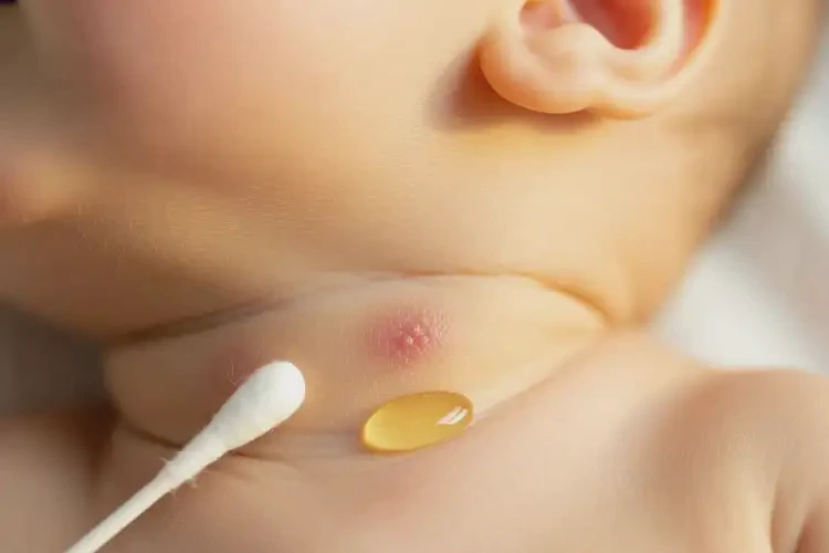 嬰幼兒脖子上有濕疹能徹底自愈嗎(圖1)