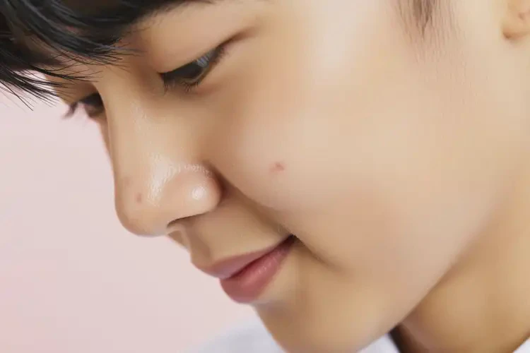 中學(xué)生面部偶爾長(zhǎng)濕疹不管它會(huì)自己自愈嗎(圖1)