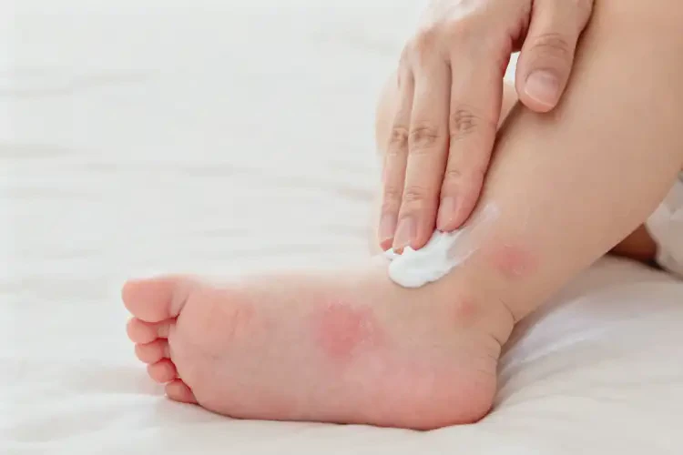 寶寶腳上出現(xiàn)濕疹能徹底自愈嗎(圖4)