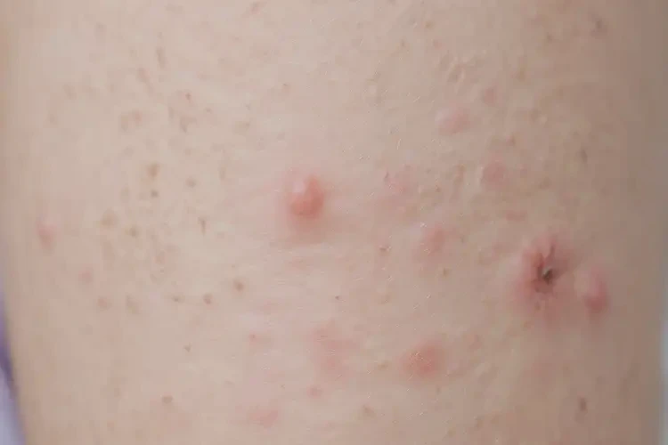 小孩手臂上偶爾長濕疹能徹底自愈嗎(圖4)