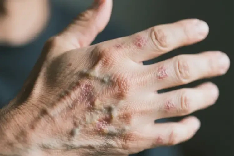 男生手上出現(xiàn)濕疹能靠自己自愈嗎(圖2)