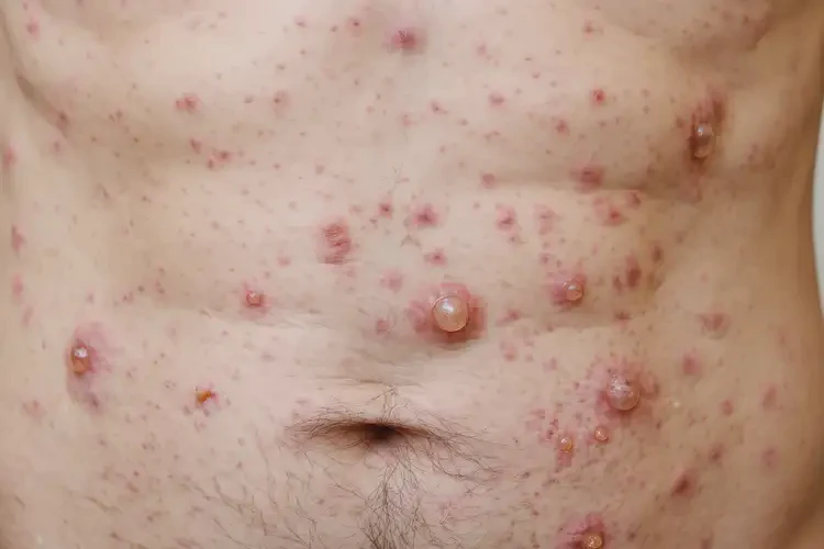 男生肚子上偶爾長濕疹不管它會自己自愈嗎(圖2)
