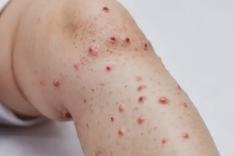 幼兒小腿上偶爾長(zhǎng)濕疹不管它會(huì)自己痊愈嗎(圖3)