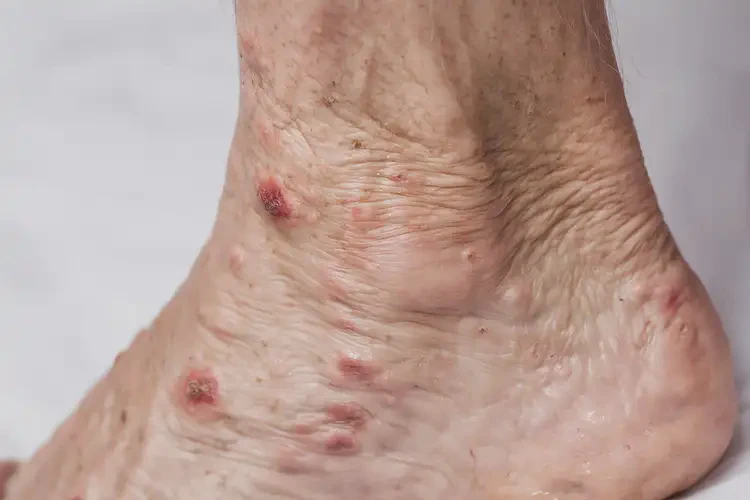老年人腳上起濕疹可以徹底自愈嗎(圖4)