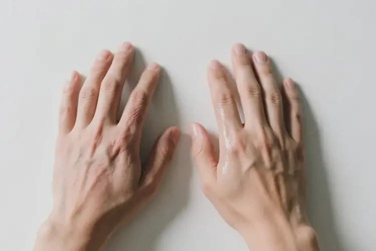 男性手上经常起湿疹可以彻底自愈吗(图2)