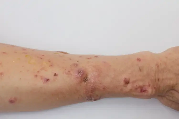 大學(xué)生小腿有濕疹不管它會自己自愈嗎(圖2)