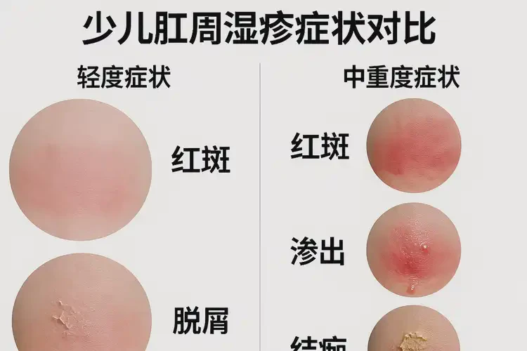 少兒屁股長濕疹不管它會自己好嗎(圖3)