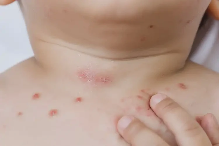 少兒脖子起濕疹能夠徹底治愈嗎(圖4)