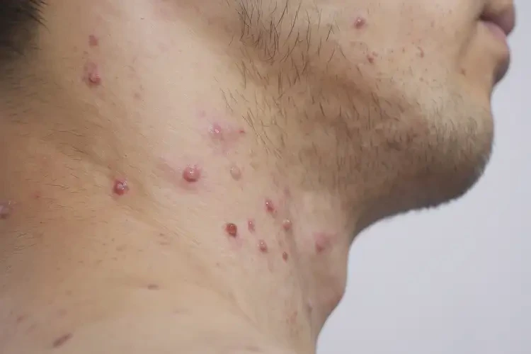 男生脖子上出現(xiàn)濕疹能夠徹底治愈嗎(圖4)