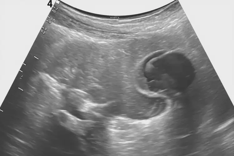 孕12周5天胎心160还要保胎吗(图4)