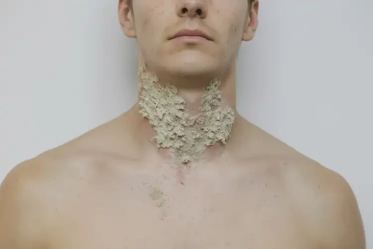 青年人脖子上有濕疹能不能徹底自愈(圖2)