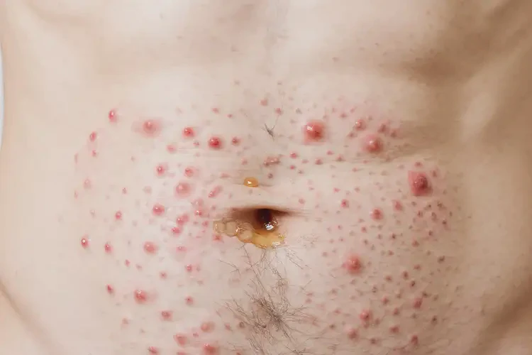 男生肚子上偶爾長濕疹不管它會自己自愈嗎(圖3)