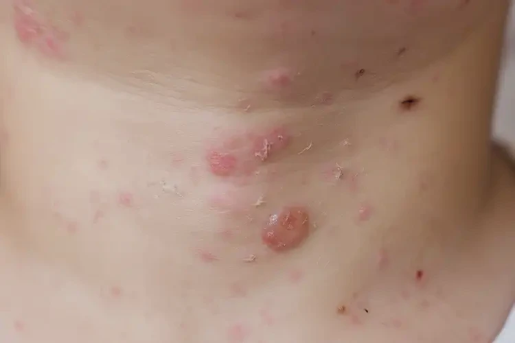 少儿脖子有湿疹不管它会自己自愈吗(图3)