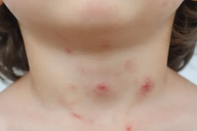 小學(xué)生脖子上經(jīng)常長濕疹可以徹底自愈嗎(圖4)