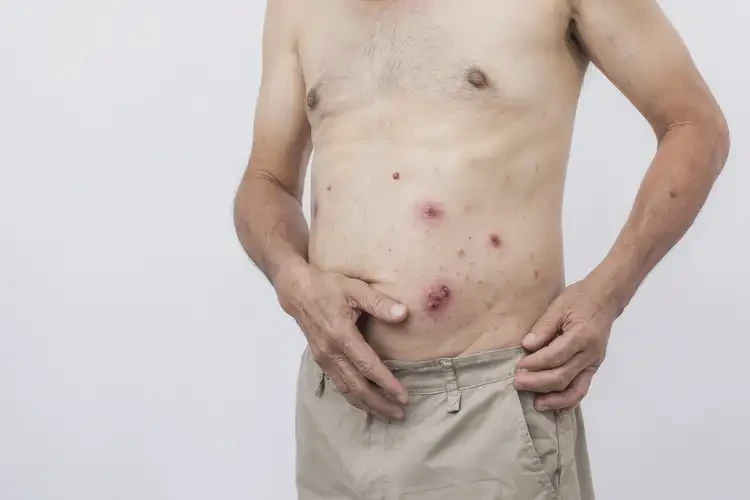 男性肚子上有濕疹能夠徹底治愈嗎(圖4)