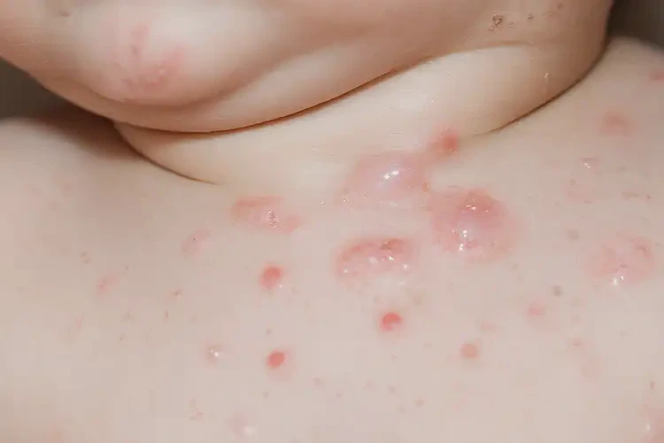 嬰兒脖子上出現(xiàn)濕疹不管它會(huì)自己好嗎(圖4)