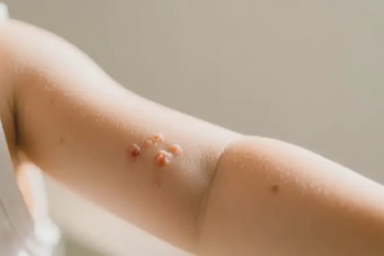 小兒手臂上偶爾起濕疹不管它會(huì)自己痊愈嗎(圖4)