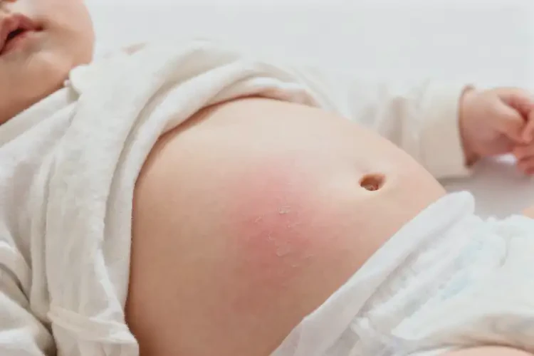 寶寶肚子出濕疹不管它會自己痊愈嗎(圖1)