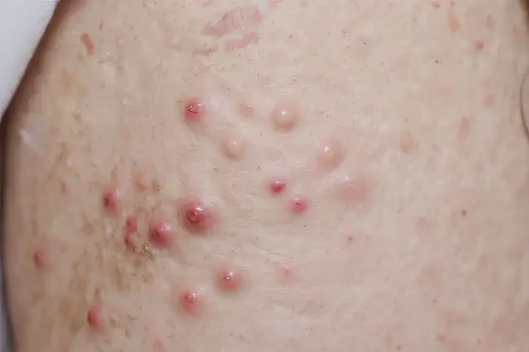 女性肛周經(jīng)常起濕疹能徹底自愈嗎(圖4)