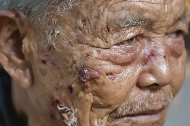 高龄老人全身经常起湿疹能不能彻底自愈(图4)