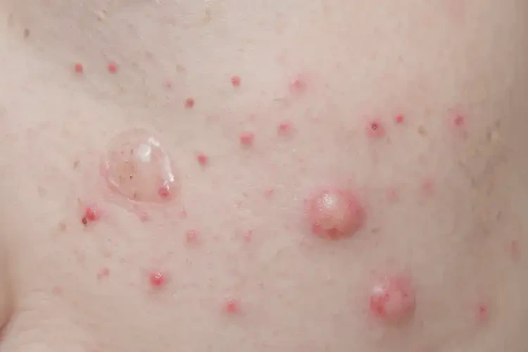 青少年肛周有濕疹可以徹底自愈嗎(圖4)