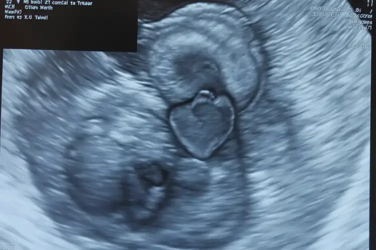 孕22周2天胎心92怎么回事(圖2)