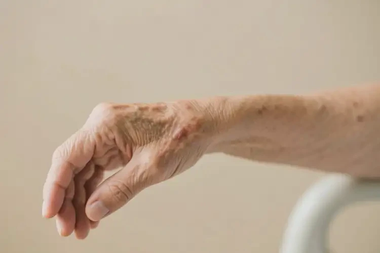 老年人手臂上偶爾起濕疹能不能徹底自愈(圖4)